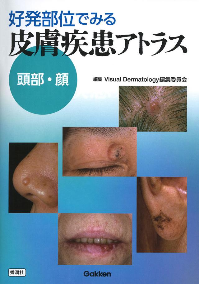 好発部位でみる皮膚疾患アトラス 頭部・顔/ＶｉｓｕａｌＤｅｒｍａｔｏｌｏｇｙ編集委員会