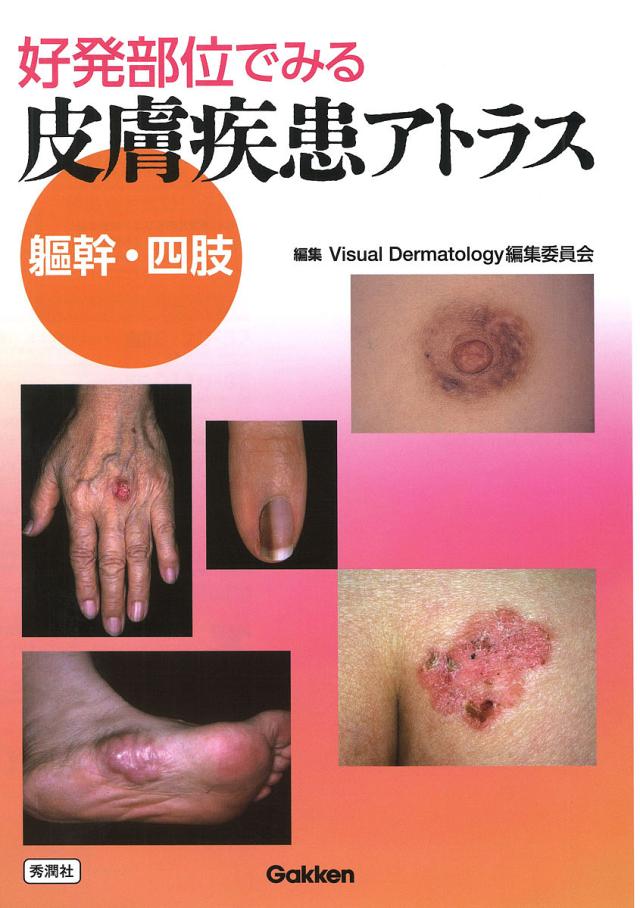 好発部位でみる皮膚疾患アトラス 躯幹・四肢/ＶｉｓｕａｌＤｅｒｍａｔｏｌｏｇｙ編集委員会
