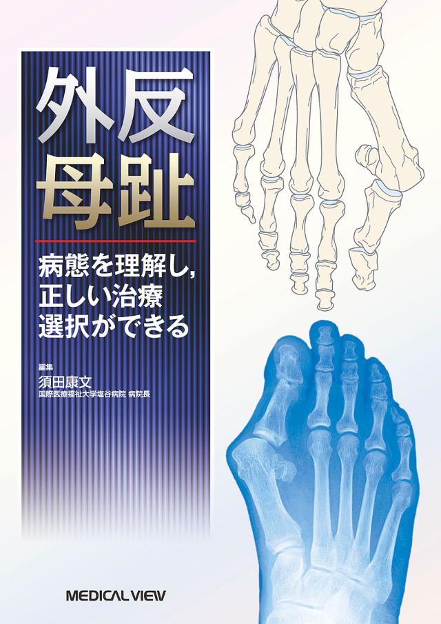 外反母趾 病態を理解し,正しい治療選択ができる/須田康文