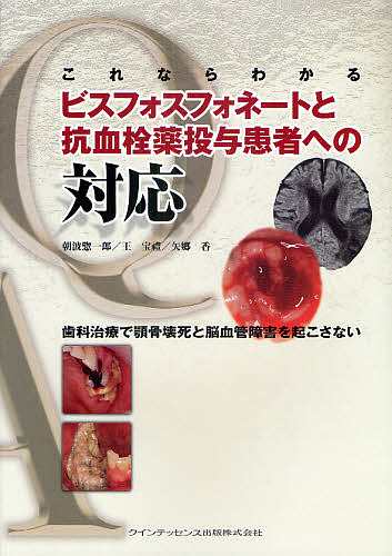 これならわかるビスフォスフォネートと抗血栓薬投与患者への対応 歯科治療で顎骨壊死と脳血管障害を起こさない/朝波惣一郎/王宝禮の通販は 5,953円
