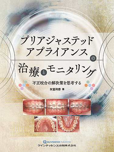 プリアジャステッドアプライアンスの治療とモニタリング 不正