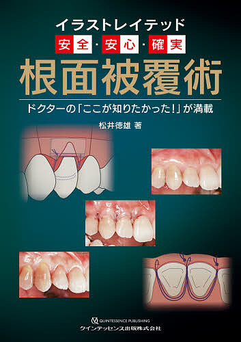 イラストレイテッド安全・安心・確実 根面被覆術 ドクターの「ここが知りたかった!」が満載/松井徳雄