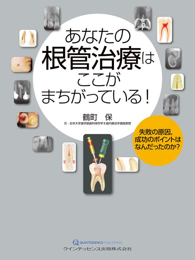 あなたの根管治療はここがまちがっている! 失敗の原因,成功のポイントはなんだったのか?/鶴町保