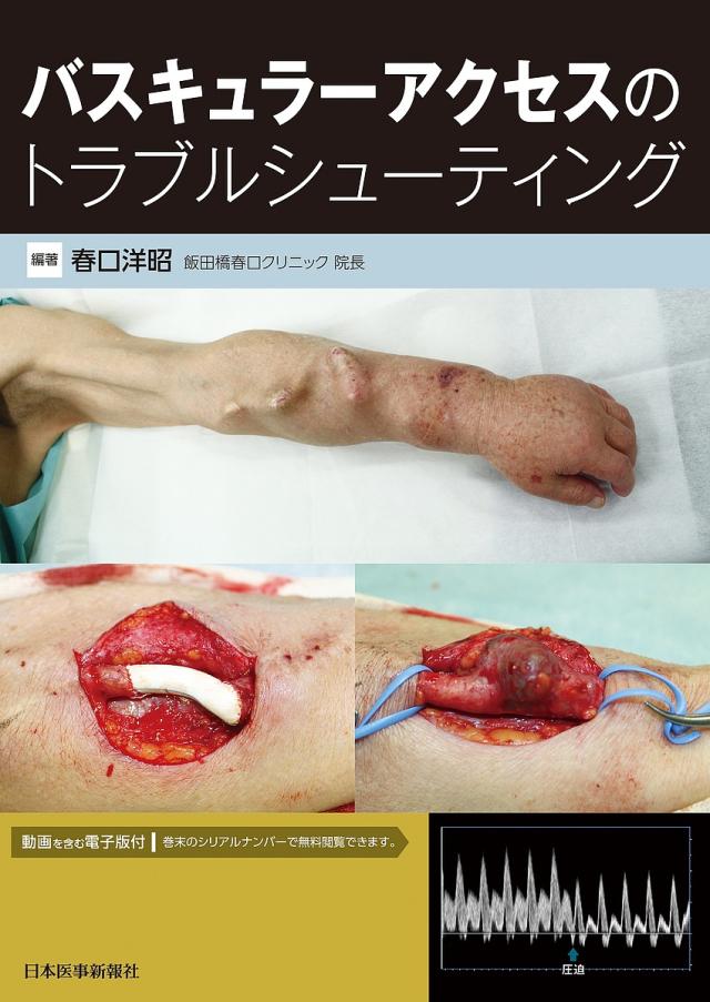 バスキュラーアクセスのトラブルシューティング/春口洋昭