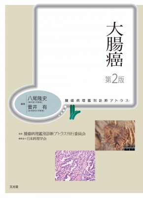 【単行本】 八尾隆史 / 大腸癌 腫瘍病理鑑別診断アトラス 送料無料