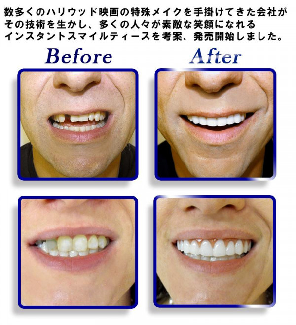 ポイント増量中 クーポンあり 仮歯 入れ歯 ホワイトニング インスタントスマイル コンフォートフィット 上用ティース 仮歯 Sml0005の通販はau Pay マーケット プロフィット