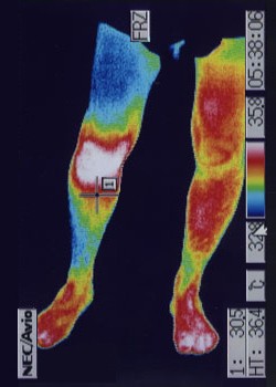 前十字靭帯損傷が原因の膝の炎症サーモグラフィー写真