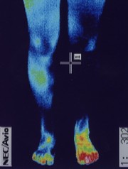 左足首捻挫　治療前　サーモ画像