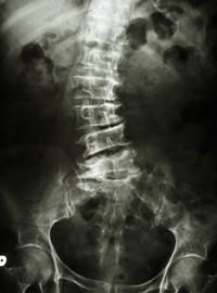 脊柱管狭窄症の腰（変形した背骨のX線画像）