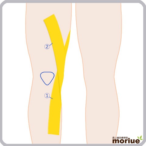 内側側副靭帯損傷を治す！＞膝サポーターのメソッド