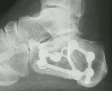 踵骨骨折の後遺症を治す 足首サポーター