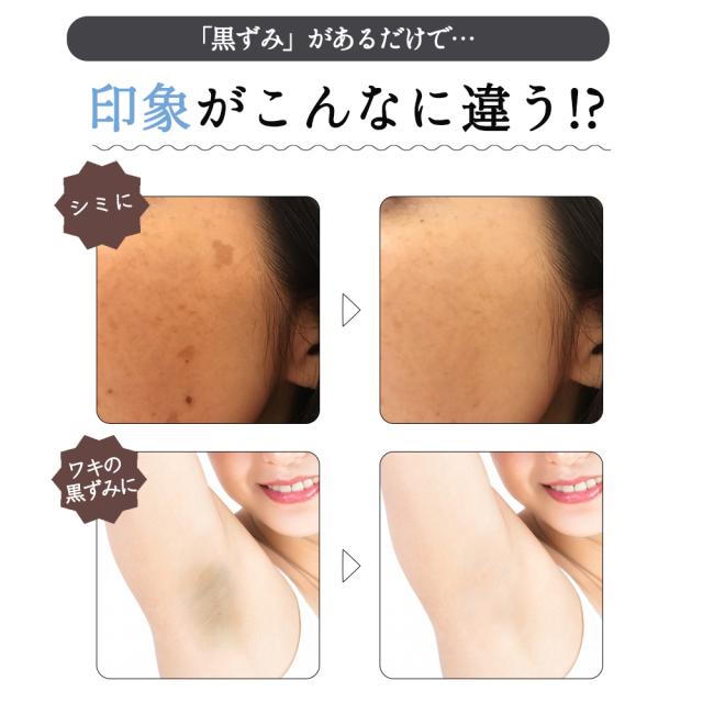 デリケートゾーン黒ずみケア ナチュレコ 薬用ホワイトクリーム 35g 黒ずみ クリーム デリケートゾーン ワキ ひじ 膝 脇 わき Vio 美白クの通販はau Wowma ワウマ ブラジリアンワックス脱毛用品のビューティーカート 商品ロットナンバー