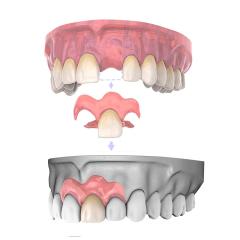 7本 カスタム 入れ歯 部分 取り外し可能 Dentellea 義歯 自然な見た目