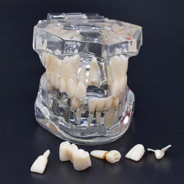 歯模型 透明 歯の模型 歯列模型 疾患展示模型 歯科模型 差し歯