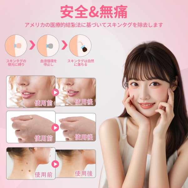 FERNIDA イボ取り除去きっと フットケア スギンタクリムーバーツール 2mm~9mm 自分で取り外す 88個バンドセット 3in1キット 顔 首 頭 脇 体 男女兼用 日本語取り扱い付き フットケア用品