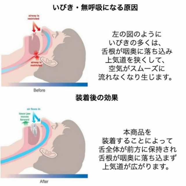 舌用 マウスピース いびき防止 無呼吸対策 口呼吸 快眠 グッズ 定形外郵便 送料無料 代引不可 の通販はau Pay マーケット ユウショウショップ