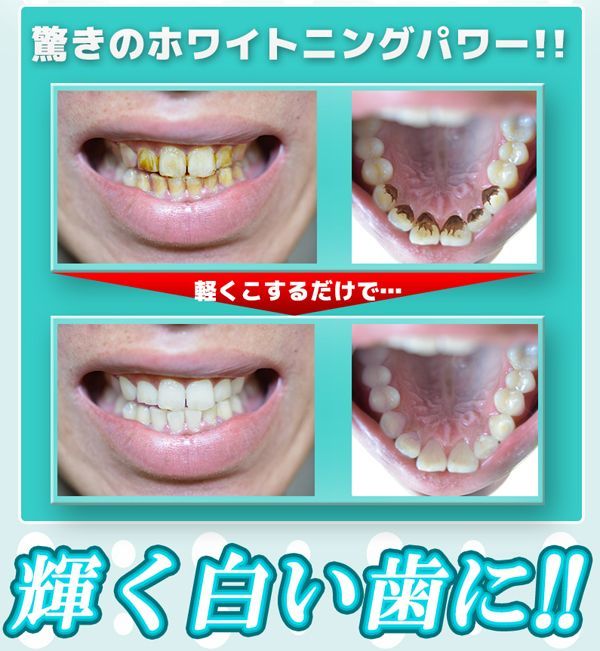 デンタルホワイトニングプロ フルセットver スティック スポンジ エナメル質 ティース ケア 超ミクロ 繊維 歯 歯磨き の通販はau Pay マーケット 株式会社ポニー