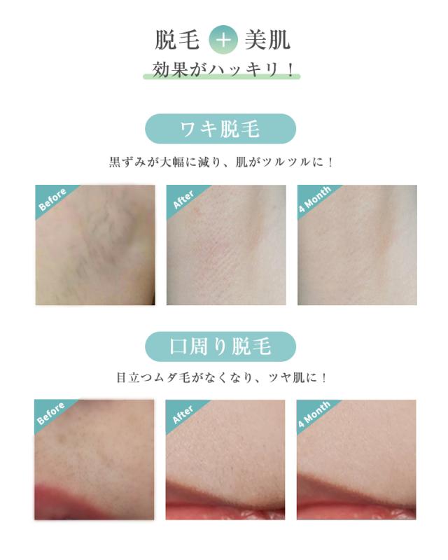 脱毛器 IPL光脱毛器 顔 髭 ワキ 腕 足 背中 ビキニライン対応 自宅 光エステ １年間保証付き 日本語取扱説明書 ギフト 【PL保険加入済み製品・安心】_13