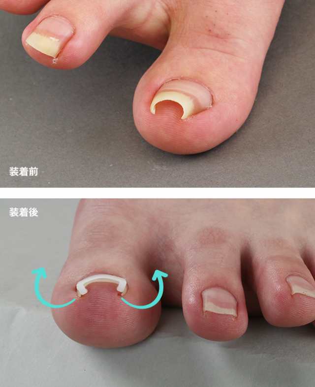 プラスウォーク 一般医療機器 巻き爪矯正シール(医療機器 日本製 巻き爪 矯正 フック まき爪 テープ 巻き爪矯正 食い込み) 即納｜au PAY  マーケット
