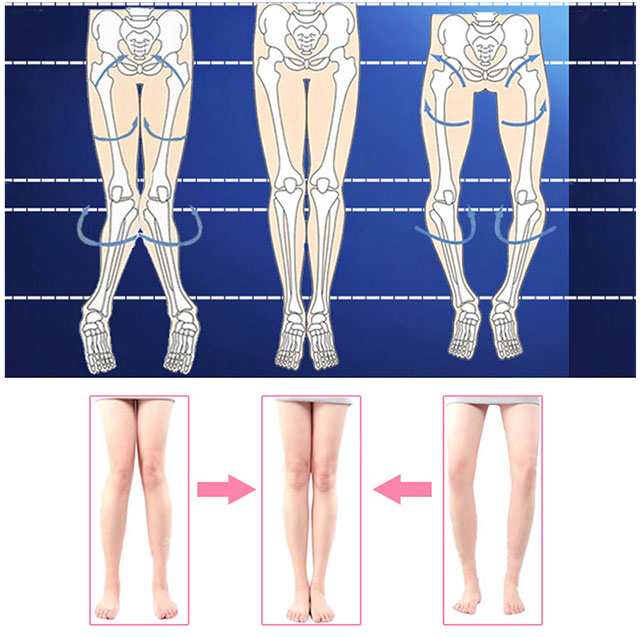 メール便送料無料 O脚 X脚 矯正 ベルト サポーター 3点セット 美脚サポートo脚矯正 X脚矯正 女性用 ジュニア用 健康グッズの通販はau Pay マーケット シンデレラ