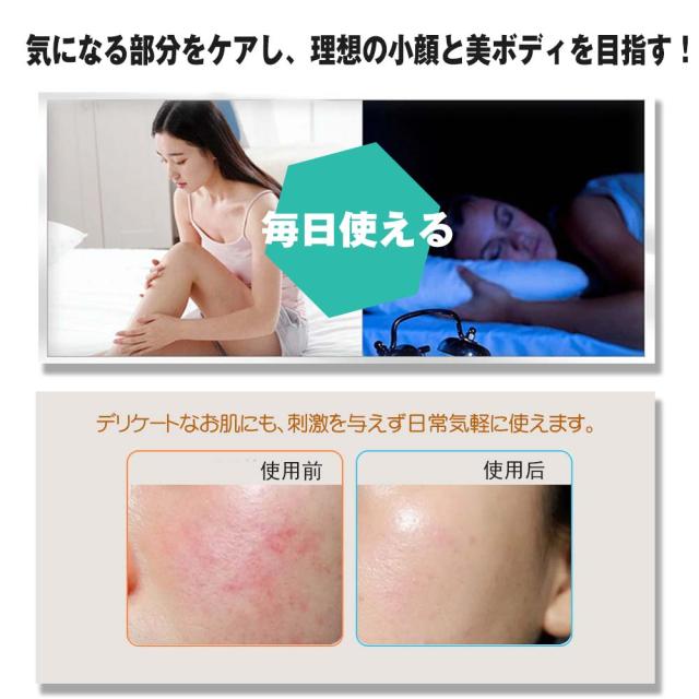 気になるほうれい線に！刺さない美容鍼♥300本　肩こりや足のむくみにも！ 気になるほうれい線に！刺さない美容鍼♥200本 肩こりなどの筋肉