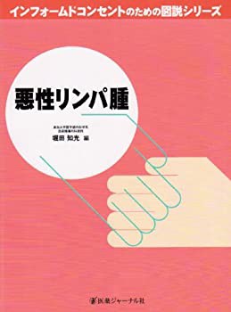 悪性リンパ腫 (インフォームドコンセントのための図説シリーズ)(未使用 未開封の中古品)の通販はその他本・コミック・雑誌