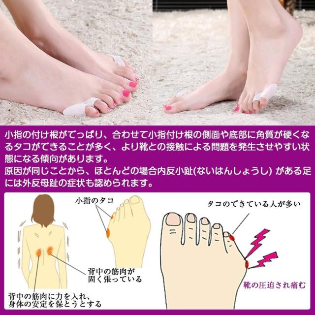 Amaritu 健康 内反小趾用4個セット 最新 超 気持ちいい 矯正パッド 靴ズレ防止ジェルパッド グッズ 予防矯正 足指広げケアの通販はau Pay マーケット 天立商店