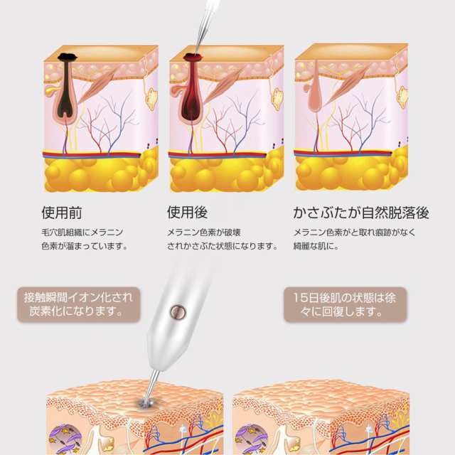 レーザーペン 新発売 美顔器 美肌 美顔 イボ 口コミ シミ ほくろ そばかす レーザースポットペン 家庭用 日本語説明書付きの通販はau PAY  マーケット - スマホスマホソフトソフト