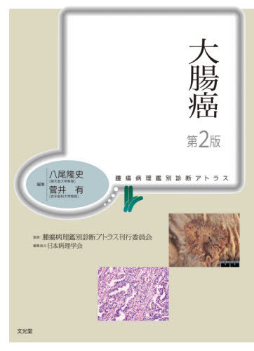 [書籍]/大腸癌 第2版 (腫瘍病理鑑別診断アトラス)/八尾隆史/編集 菅井有/編集 腫瘍病理鑑別診断アトラス刊行委員会/監修 味岡洋一/〔ほか〕執筆/NEOBK-2612030