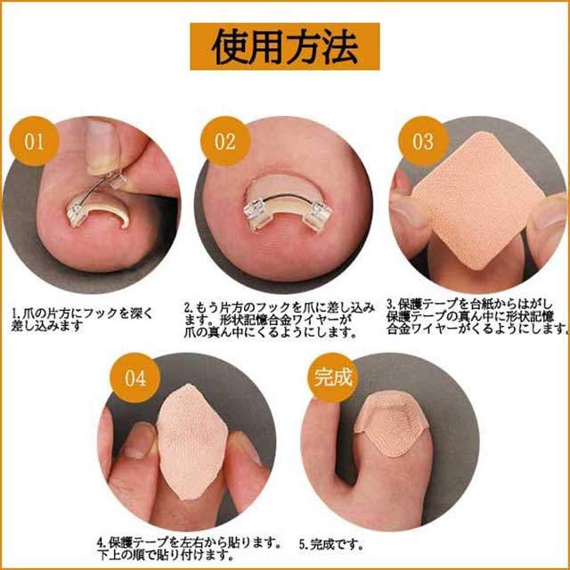 800円クーポン配布中 巻き爪ワイヤーガード 2個セット 一般医療機器 巻き爪 治療 クリップ テープ ワイヤー 矯正 巻爪 治し方の通販はau Pay マーケット 美活応援店 アットシュシュ Au Pay マーケット店