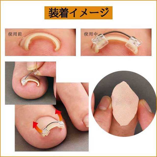 お金を節約 効果絶大 12本 セット 巻き爪 矯正器具ステンレスワイヤー