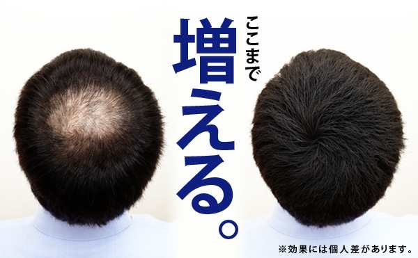 増毛スプレー【送料無料】newヘアフォロー 同色 5本セット【正規品】生え際やつむじはげ、分け目部分の薄毛をカバーする、ハゲ隠しスプレ