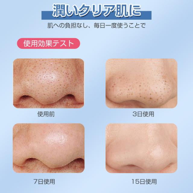 毛穴•角質ケア/美顔器 ✴︎おまけ付き✴︎ おまけ付き】 美顔器 フェイスケア 毛穴 ミテス MITESU 黒ずみ