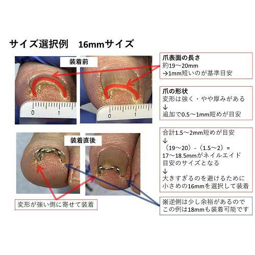 巻き爪 治療 巻き爪矯正 【 ネイル・エイド １４ｍｍ】 クリップ ワイヤー ガード 爪ブロック 切り方 テープ ロボ 靴 巻き爪用やすり 巻爪  グッズの通販はau PAY マーケット - 巻き爪・陥入爪治療の相談室 au PAY マーケット店 | au PAY マーケット－通販サイト