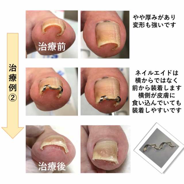 巻き爪 矯正 自分で 治療 【 ネイル・エイド １６ｍｍ】 ワイヤー