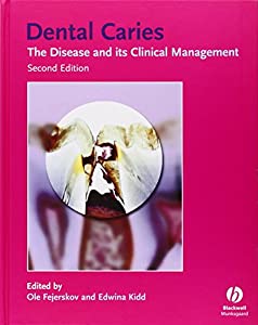 Dental Caries: The Disease and Its Clinical Management(中古品)の通販は 15,408円