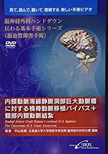 内頸動脈海綿静脈洞部巨大動脈瘤に対する橈骨動脈移植バイパス+頸部内頸動脈結紮—Radial Artery Graft Bypass + cervical ICA l