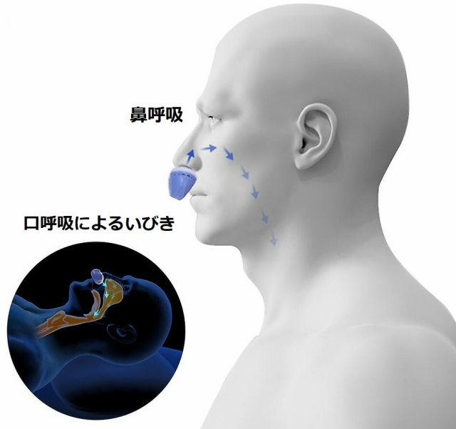 いびき トップ 市販 グッズ