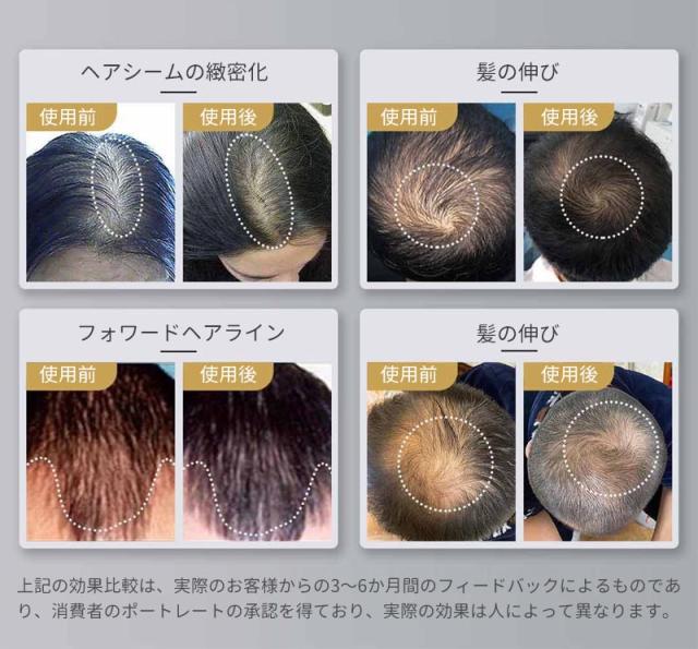 育毛キャップ 　赤色 led 育毛　育毛システム81個 育毛 ヘルメット 治療ライト 脱毛 薄毛治療 男女共用 副作用のないヘ髪の再生 超軽量 操作簡単 安全装置搭載 USB給電式　頭皮_9