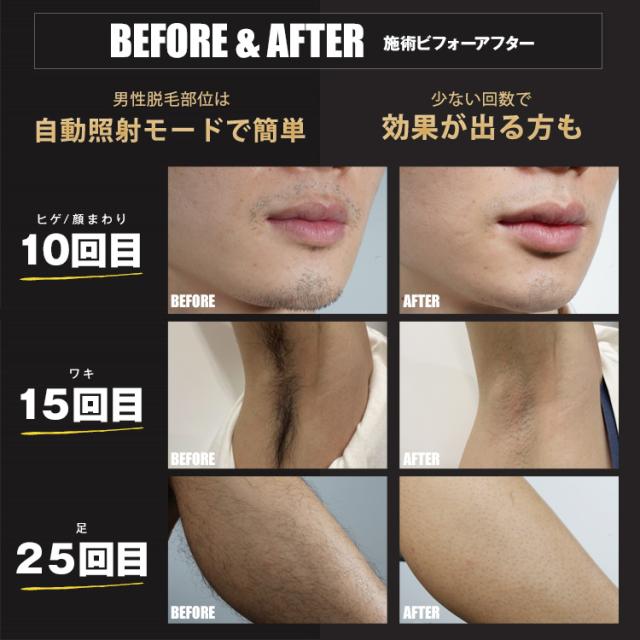 最新 脱毛器 カテゴリー美顔器 |公式 JOVS Dora 次世代ハイパーIPL