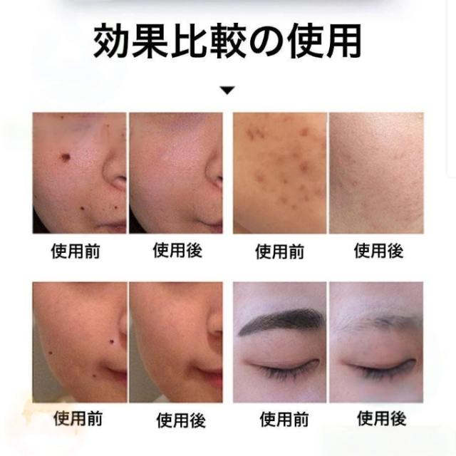 ピコレーザー 美顔器 レーザーペン シミ取り ほくろそばかす除去