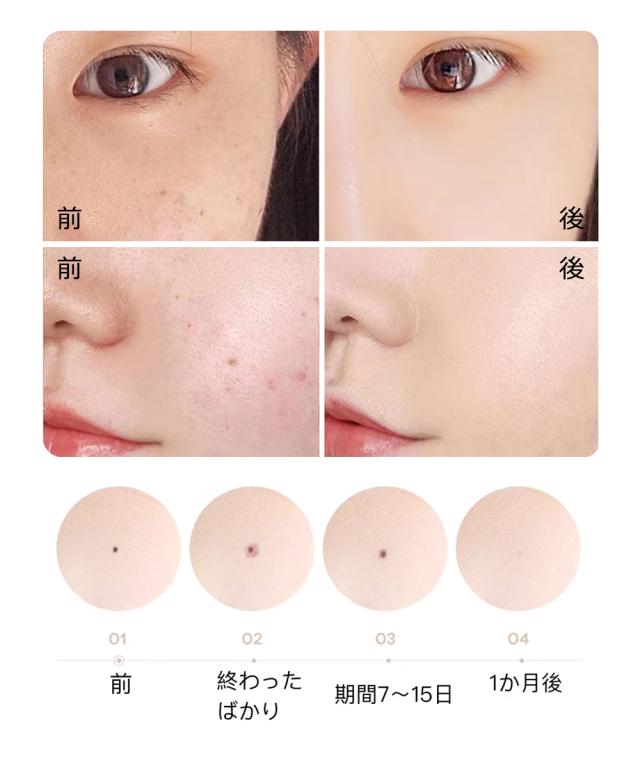 ほくろ除去ペン 最新 正規品 レーザーペン 美顔ペン 美顔器 9段階調節