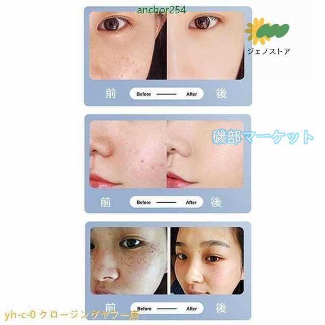 ピコ美顔器　青レーザー ピコレーザー 美顔器 レーザーペン シミ取り ほくろそばかす除去