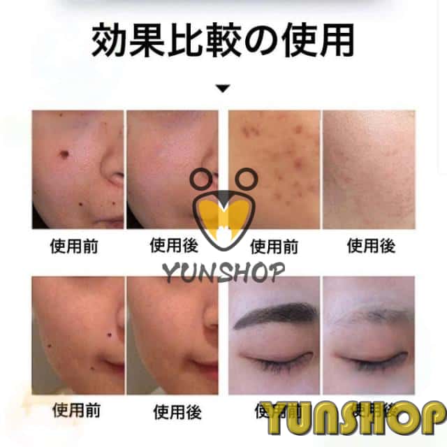 2025 レーザーペン ピコレーザー 美顔器 シミ取り 青色レーザー 赤色