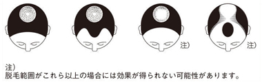 【第1類医薬品】アートネイチャー ラボモ ヘアグロウ ミノキシ5 ネオ 72mL 2本 セット 発毛剤 育毛剤 ミノキシジル 5% AGA 男性用 毛生え薬 薄毛対策 発毛 育毛 養毛 男性 メンズ 発毛促進 抜け毛 脱毛症 薄毛 脱毛 頭皮 送料無料 LABOMO 公式_16