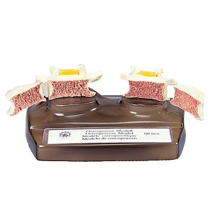 骨粗しょう症模型(SR-326)(送料無料)_1