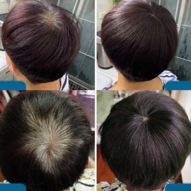 ヘアピース 部分ウィッグ トップカバー つむじ 人毛100% 前髪 ヘアピース 部分ウィッグ トップカバー つむじ 人毛100% 前髪
