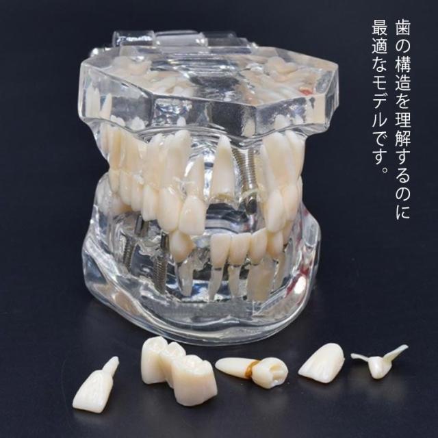 透明 開閉式 歯の模型 歯模型 疾患展示模型 モデル 用 歯医者 人体解剖