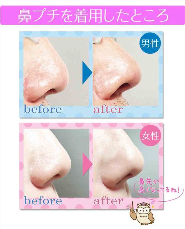 整形級に鼻が高くなる！鼻プチ 3サイズセット／国内検品済み/韓国