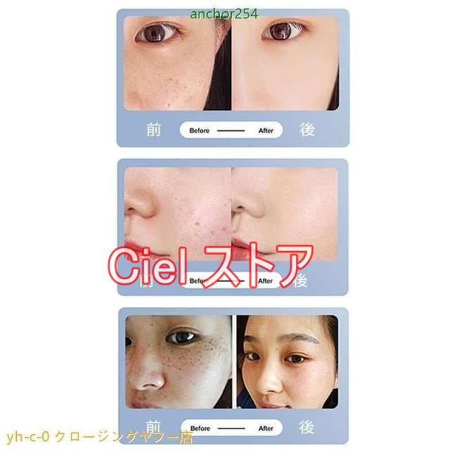 美顔器 ピコレーザー 美顔器 ほくろそばかす除去 シミ 斑 青色